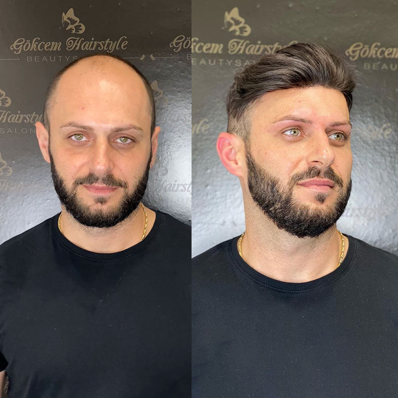 Lace Hair Replacement System
