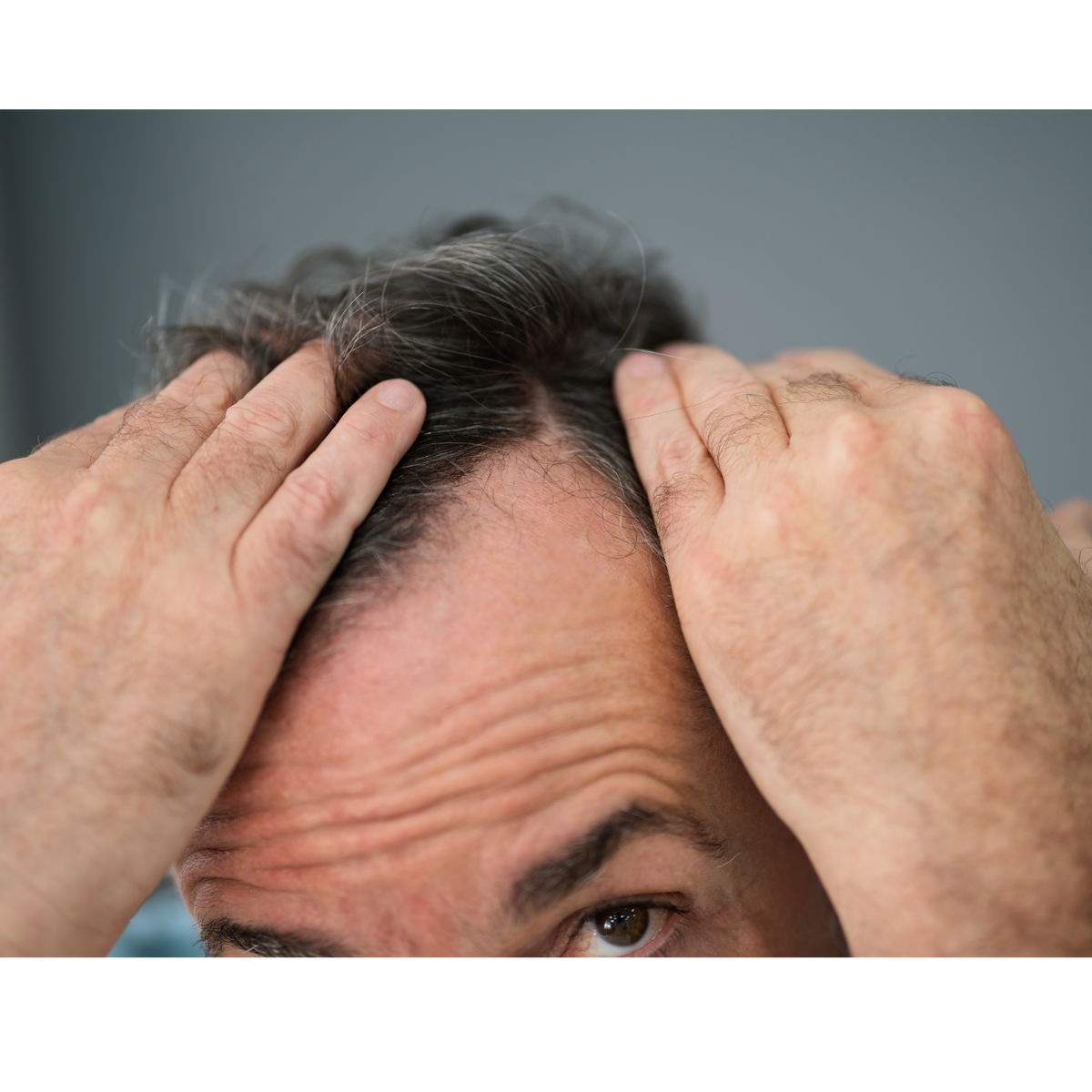 Hair Loss Solutions in Australia: An Honest Guide to Every Option (2026)