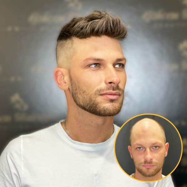 Monofilament Hair Replacement System