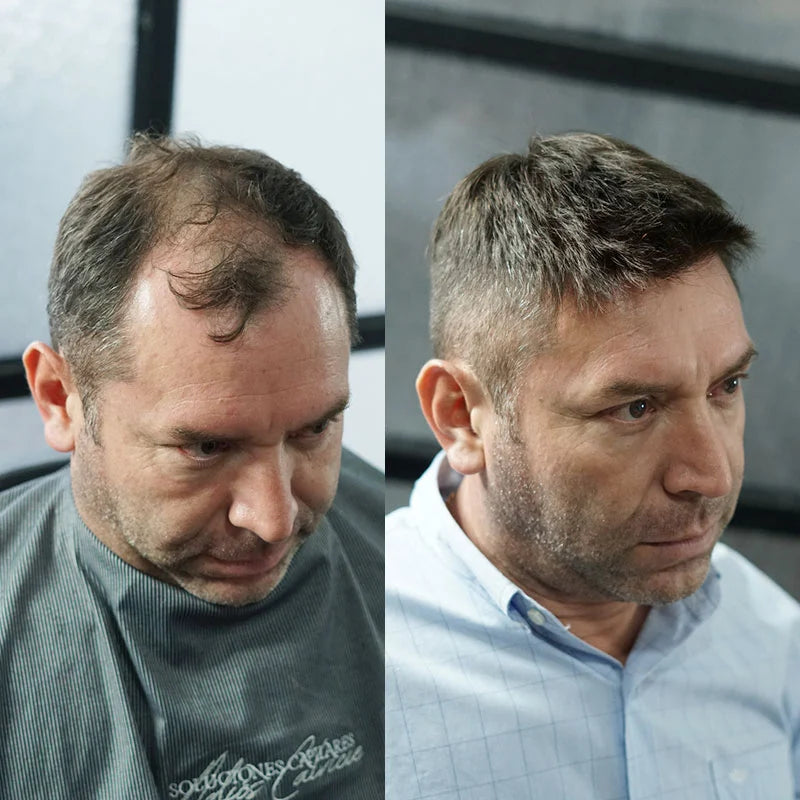 Poly Skin Hair Replacement System
