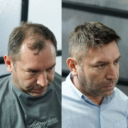 Poly Skin Hair Replacement System