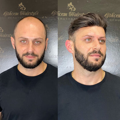 Lace Hair Replacement System