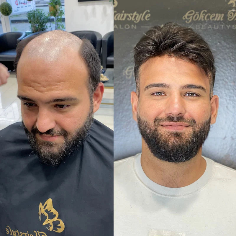 Monofilament Hair Replacement System