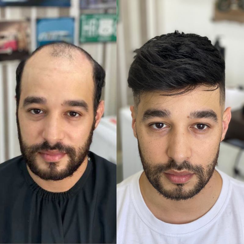 Poly Skin Hair Replacement System
